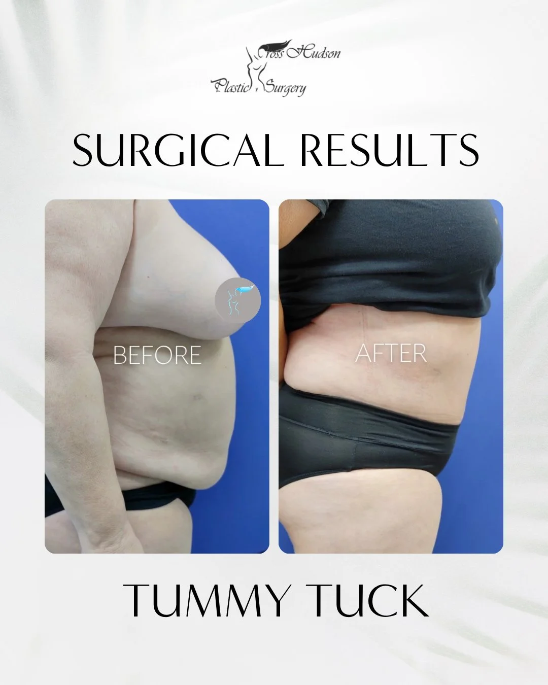 Cross Hudson Plastic Surgery logo and tummy tuck before-and-after comparison showing abdominal contour improvement